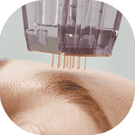 microneedling